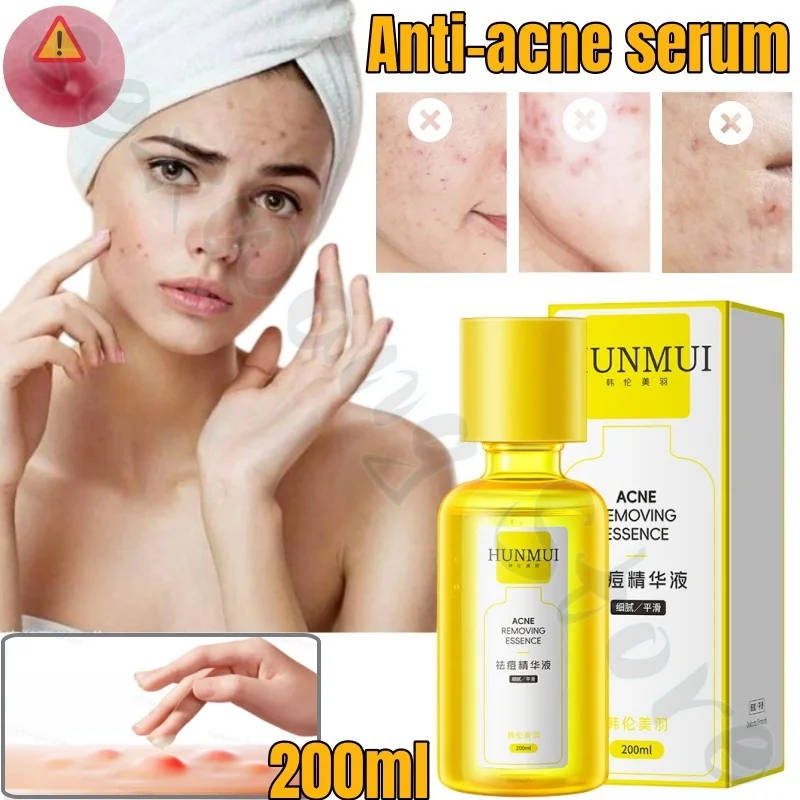 

200ml Han Lun Meiyu Essence fades acne marks, closes acne, soothes and tightens skin, nourishes, hydrates and moisturizes face