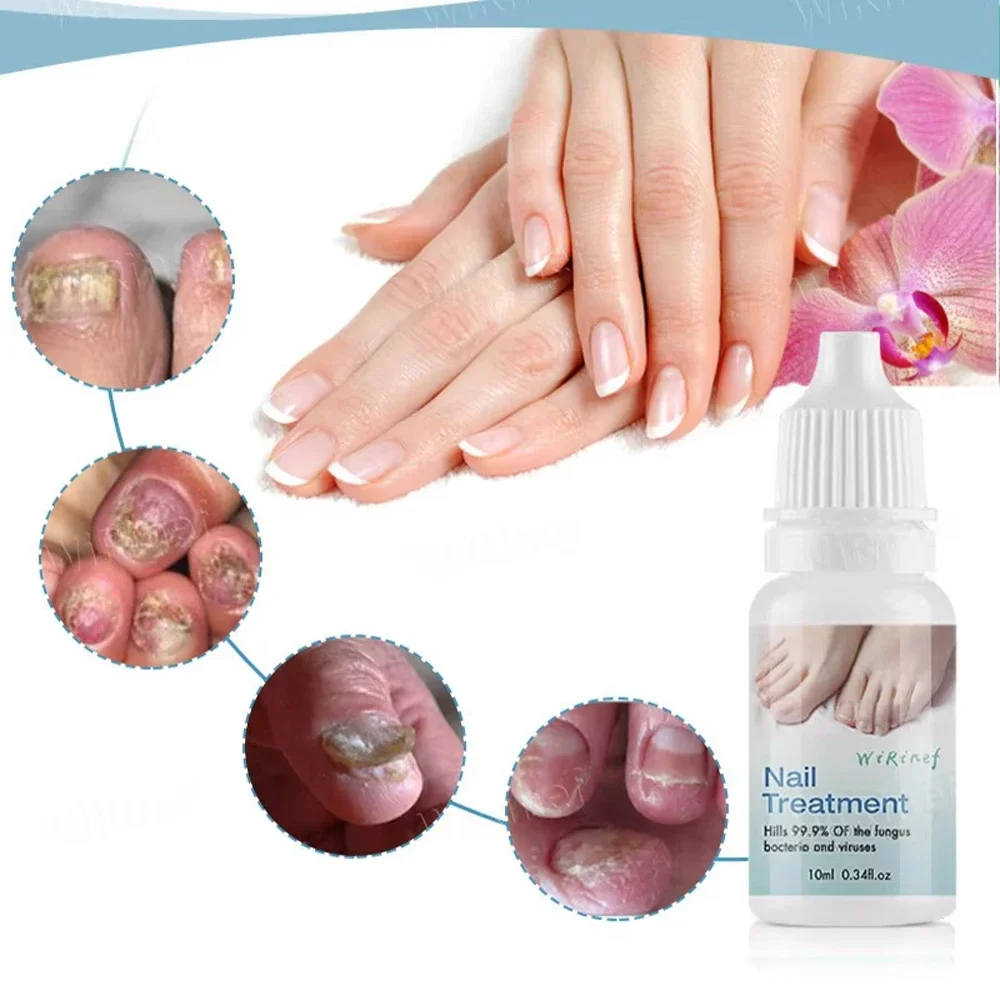 Nail Fungus Treatment Serum Toe Nail Fungus Removal Essence Anti Infection Paronychia Onychomycosis Hand Foot Nail Care Cream