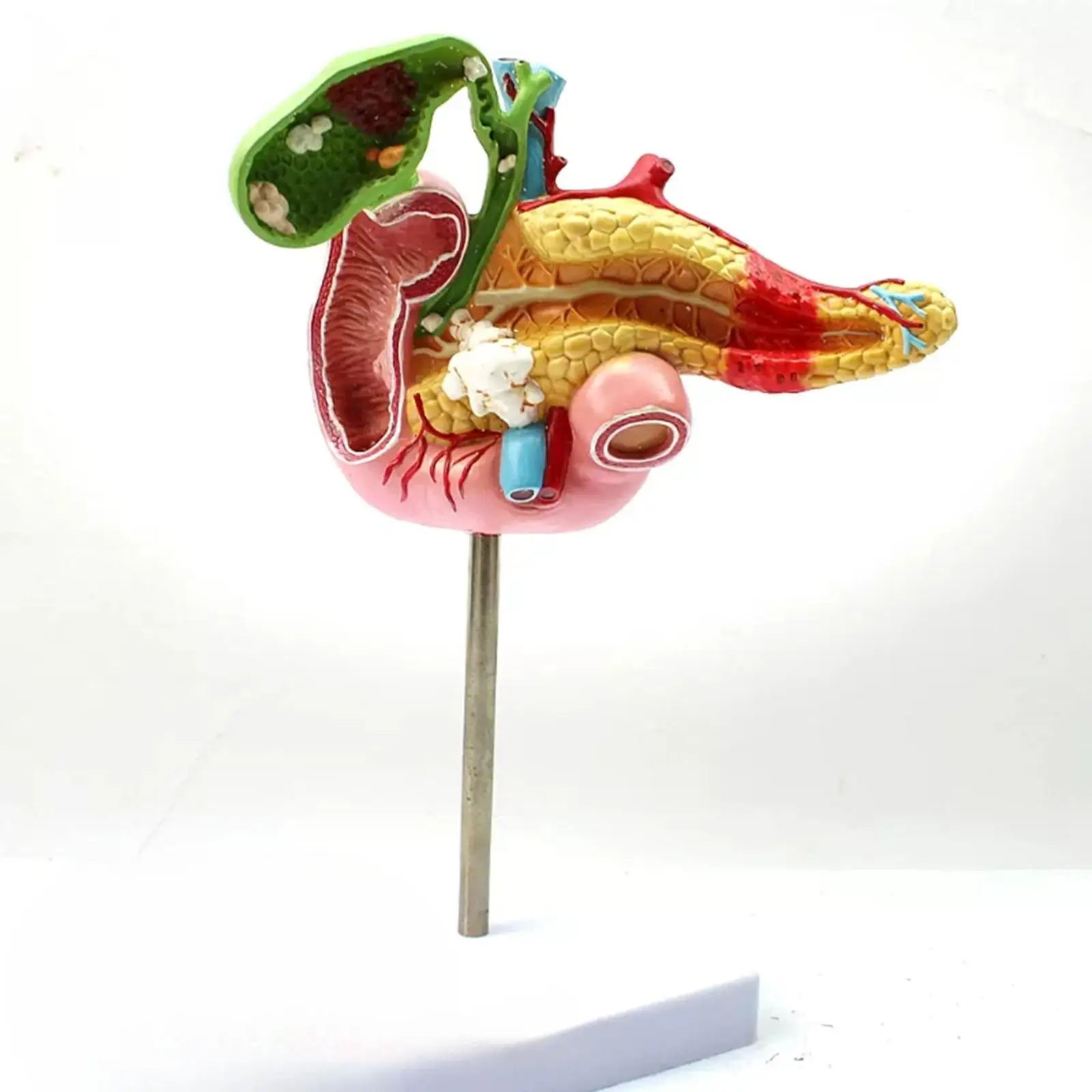 

Human Cholecystitis Polyps Gallstones Duodenal Ulcer Model Medical School