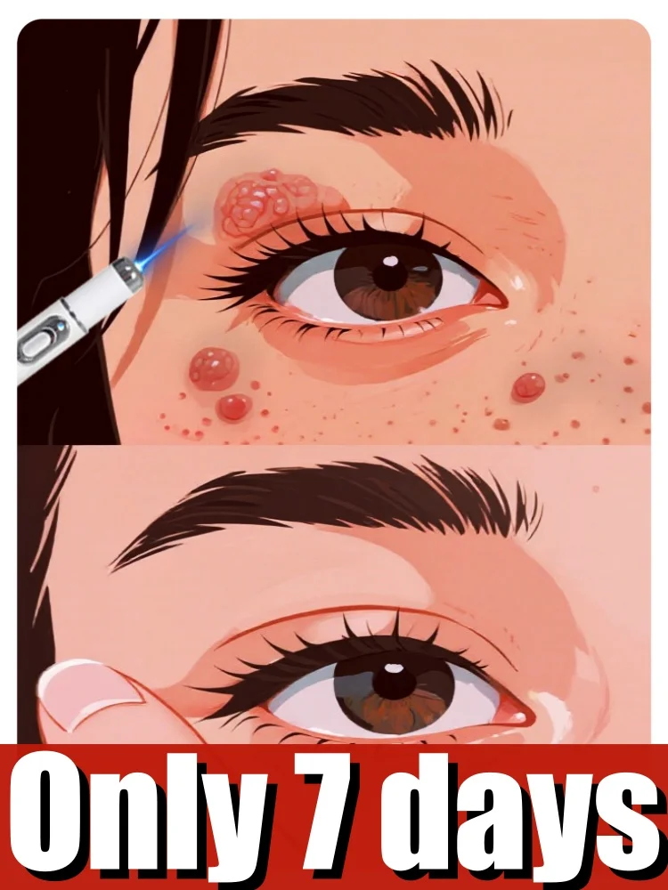 

Universal wart management tool: Take care of your skin and say goodbye to wart troubles