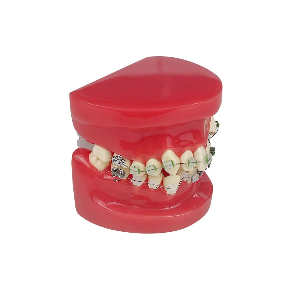 Modello ortodontico dentale Trattamento dei denti di corvo Modello didattico standard Modello di denti dentali con bretelle in metà metallo e metà ceramica