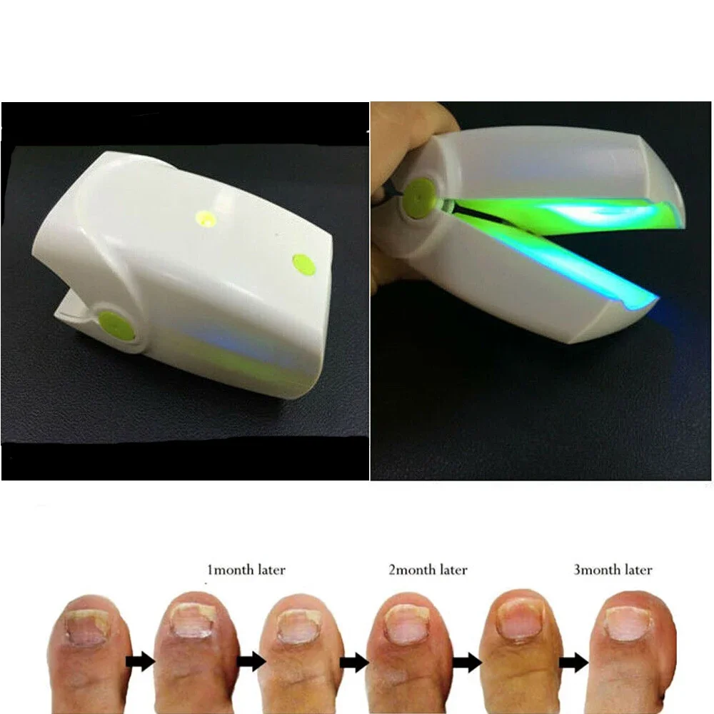 Potable Laser Onychomycosis Treatment Device Low Level Laser Therapy Instrument For Finger Nails Toe Nails Fungus No Pain