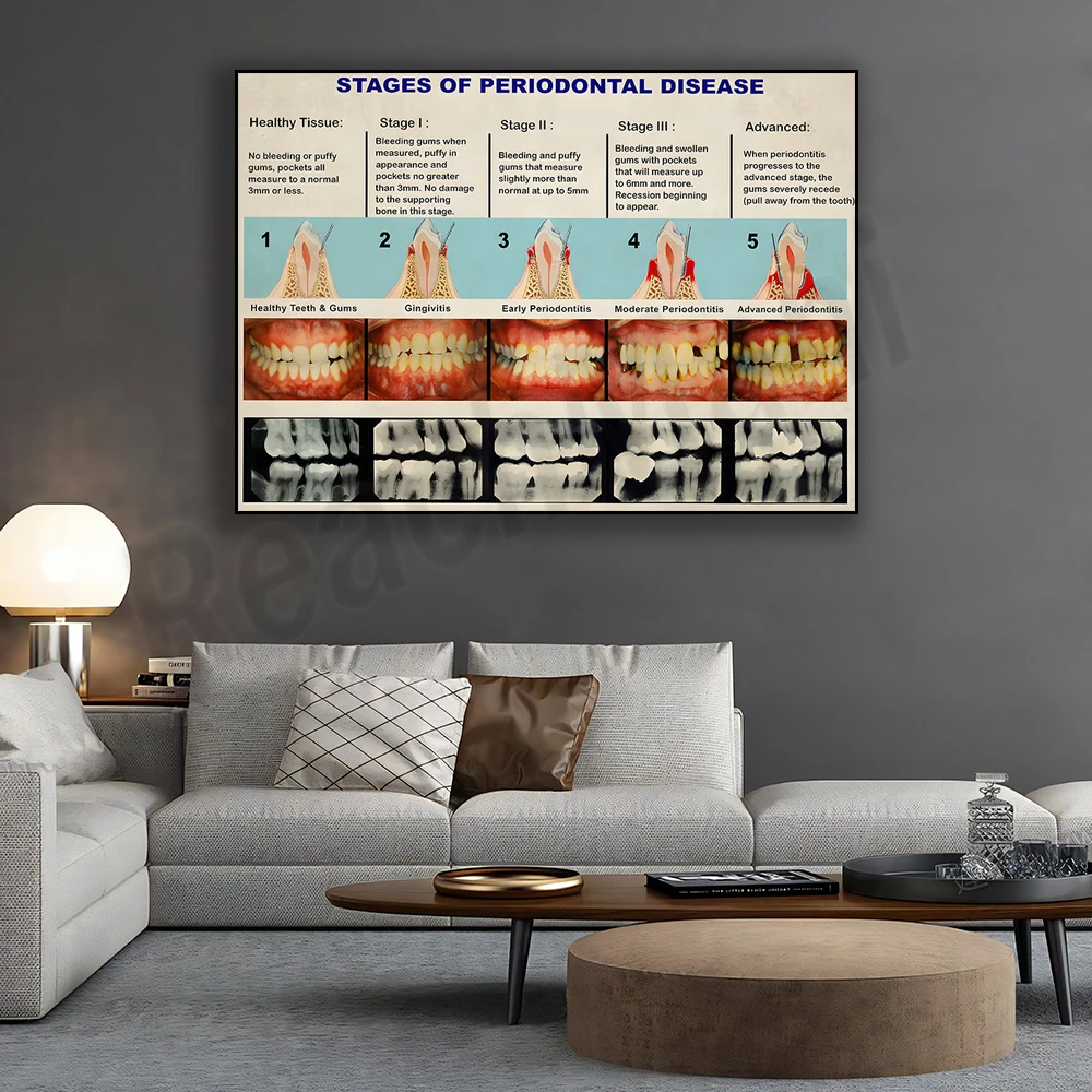 

Dental Knowledge Poster, Periodontal Disease Poster, Vintage Stages Poster Wall Art Dentist Office Hospital Clinic Science Decor