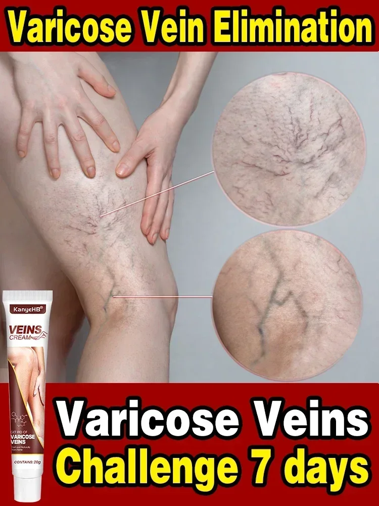 

Effective Varicose Vein Relief Relieve Pain Herbal Ointment Eliminate Vasculitis Phlebitis Spider Legs Treatment Soothing