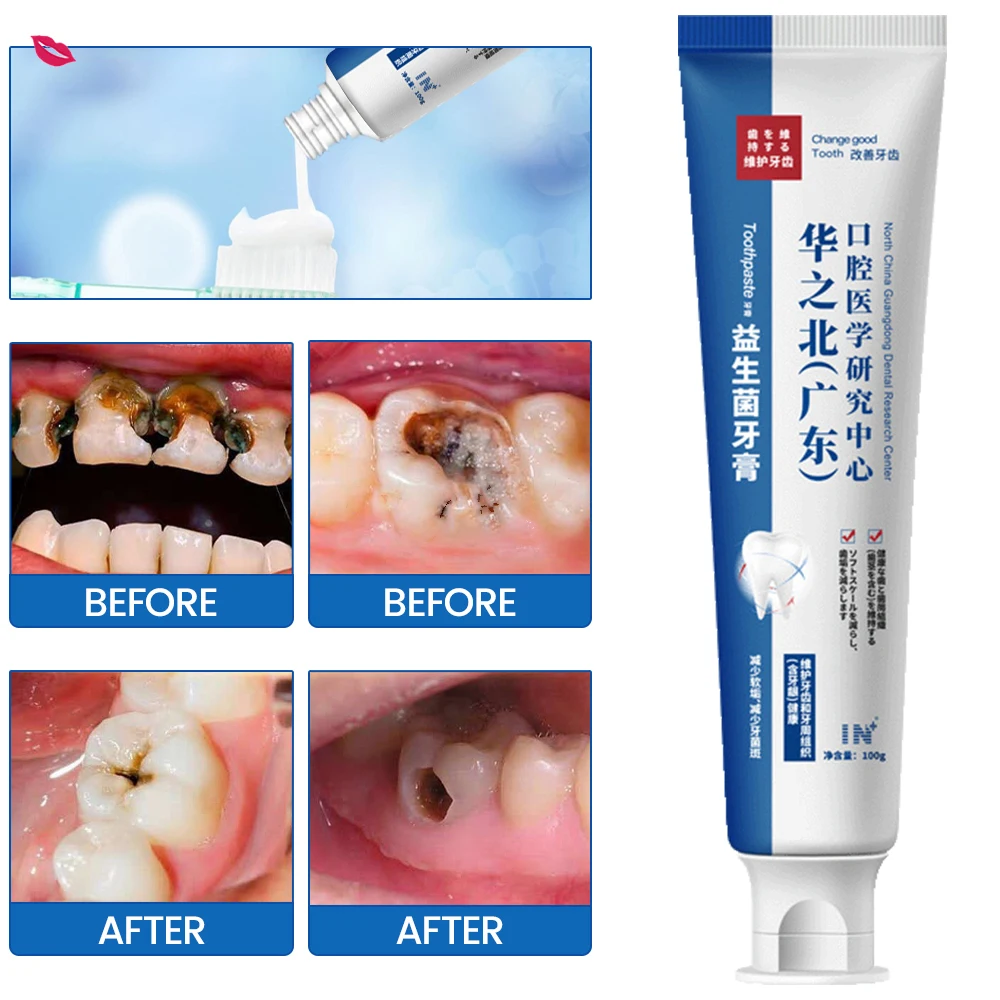 Toothpaste of Teeth Whitening Repair of Cavities Caries Removal of Plaque Stains Decay Repair Teeth Treating Dental Calculus