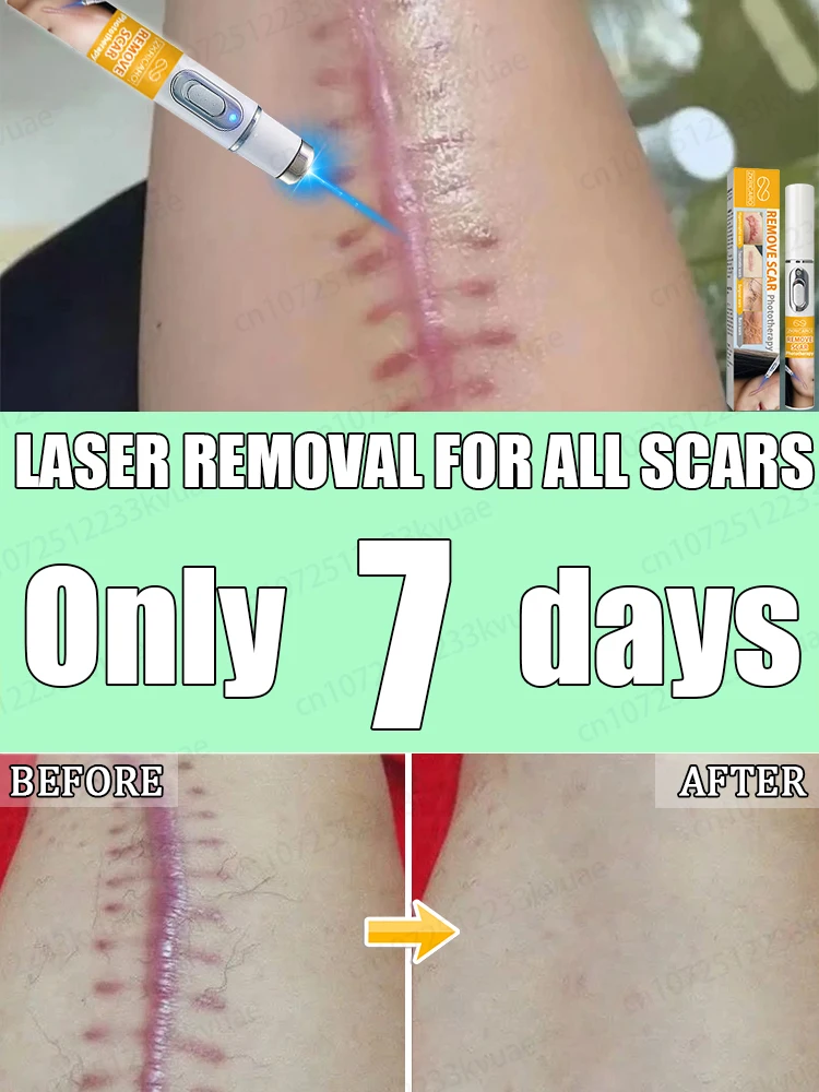 

ᴸᵃˢᵉʳ ˢᶜᵃʳ ʳᵉᵐᵒᵛᵃˡ⸴ ᑫᵘⁱᶜᵏˡʸ ʳᵉᵐᵒᵛᵉˢ ᵃˡˡ ᵗʸᵖᵉˢ ᵒᶠ ˢᶜᵃʳˢ‧