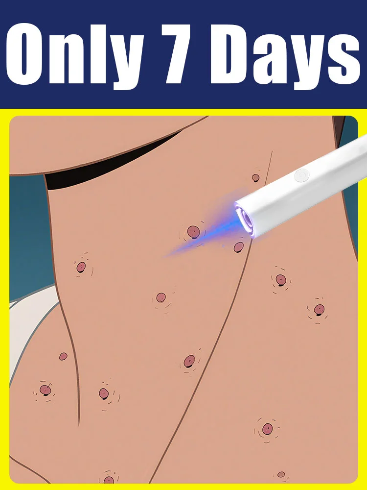 เครื่องมือดูแลหูด ลดราคาพิเศษ