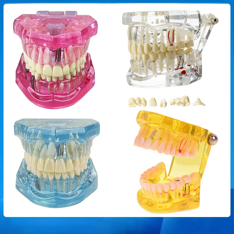 

Removable Teeth Model Dental Model Teeth Implant Restoration Bridge Medical Teaching Study Disease Dentist Demonstration Model