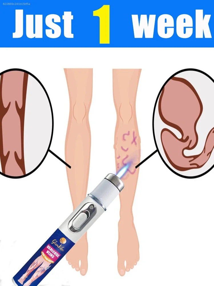 

Slowly "smooth out" bulging veins in the legs.