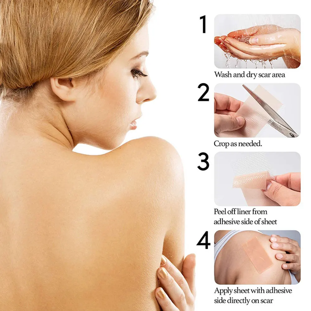 4 سنتيمتر * 50 سنتيمتر ندبة ورقة إزالة قطاع الطفل الأذن مصحح هلام السيليكون ندبة التصحيح قطاع لحب الشباب كيلويد جراحة حرق العلاج #4