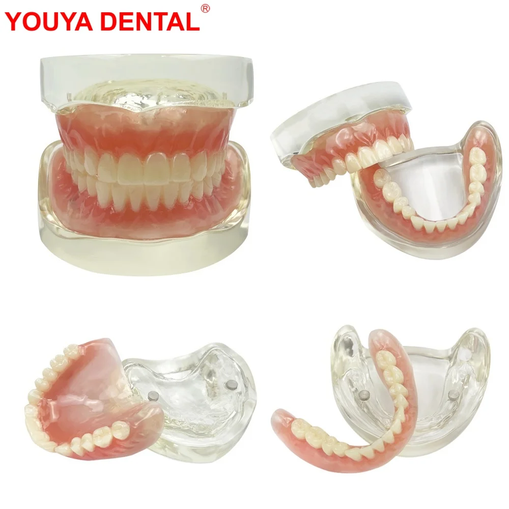 

Dental 2 Implant Teeth Model For Teaching Education Study Dentistry Maxillary/Mandibular Overdenture Upper/Lower Jaw Tooth Model