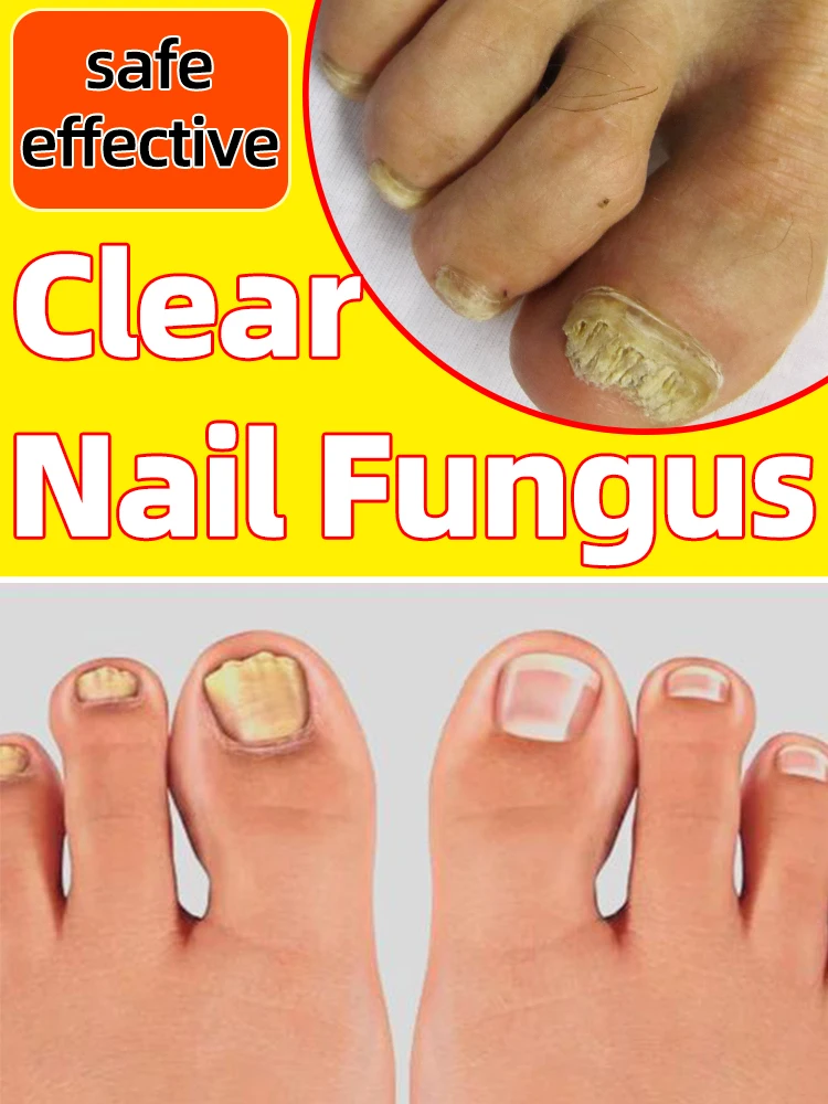 finger nail Fungus medicine