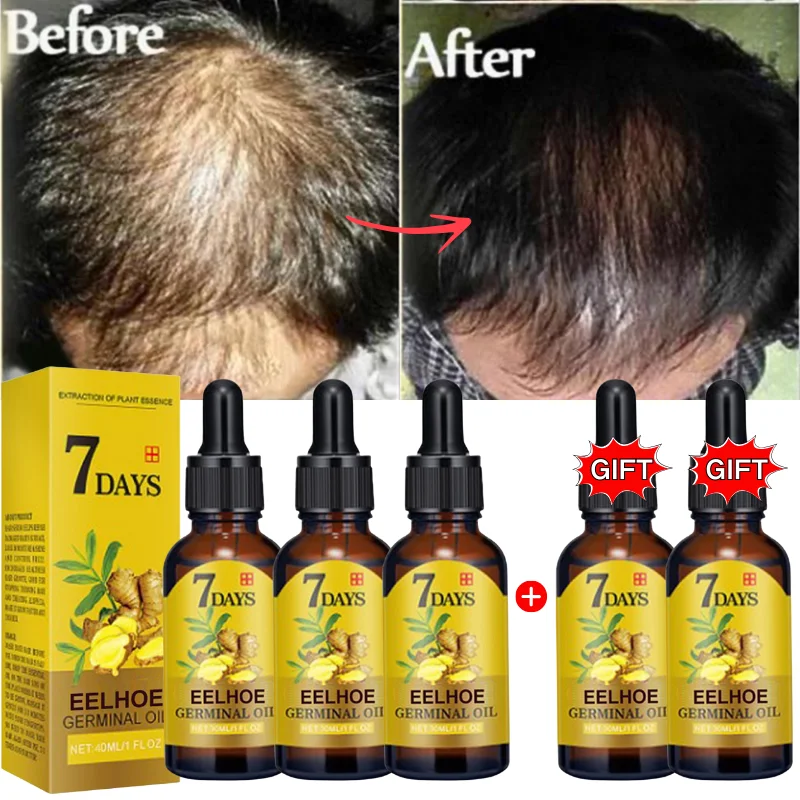

Ginger Hair Growth Serum Anti Hair Loss Fast Growing Hair Care Essential Oil Repair Damaged Scalp Treatment For Women Men