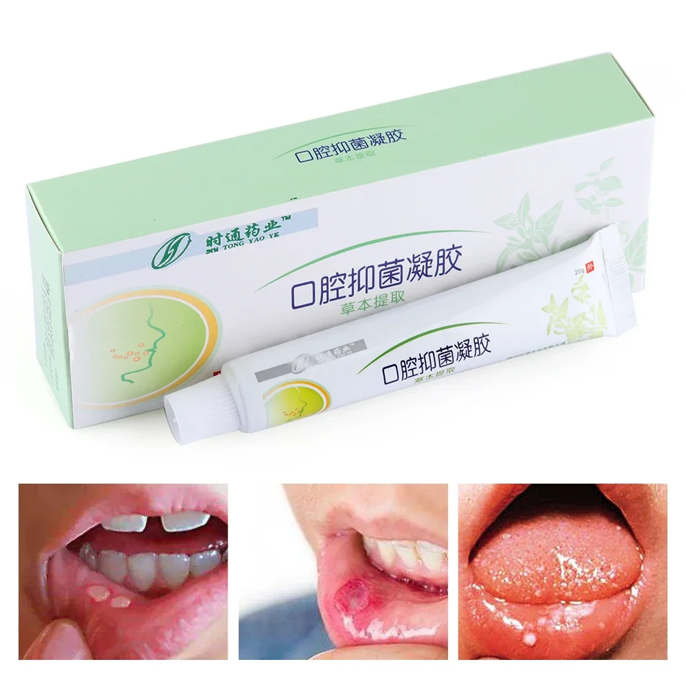 Mouth Ulcer Relief Gel Natural Herbal Oral Hygiene Antibacterial Cream Severe Pain Irritation Bad Breath Inflammation Creatina