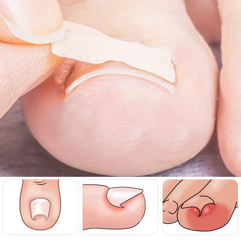 New Ingrown Toenail Corrector Patches Paronychia Treatment Recover Corrector Pedicure Foot Nail Correction Stickers 100pcs/bag