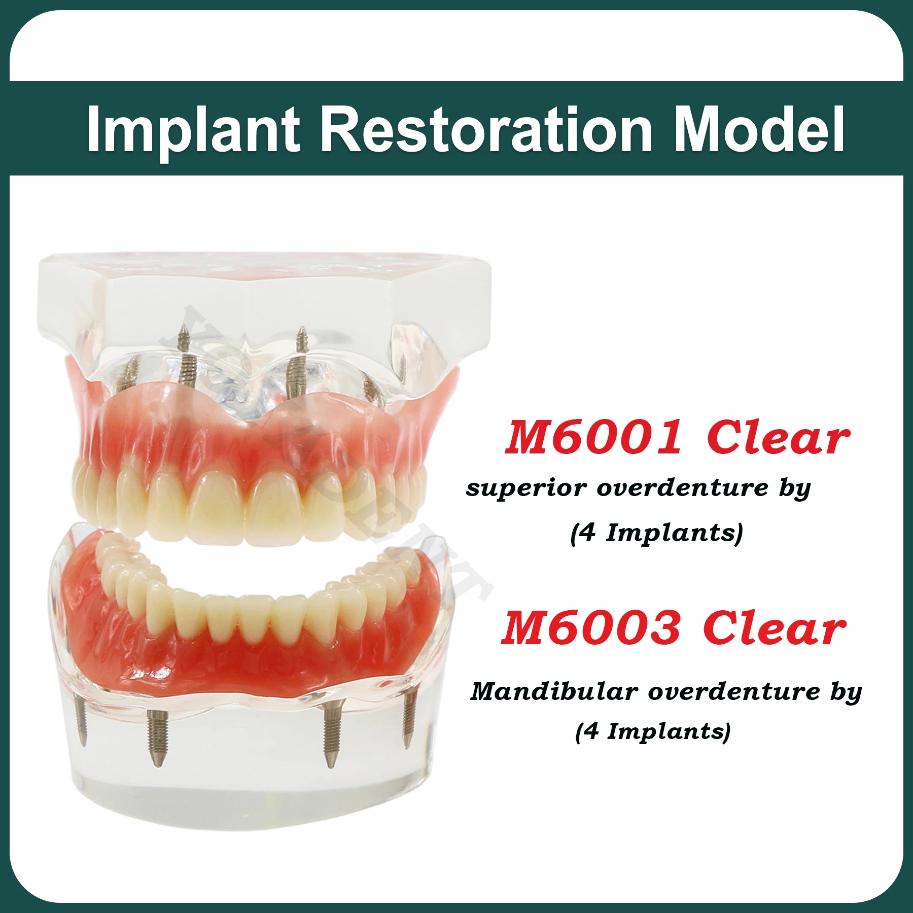 Dental Implant Teeth Model Removable Overdenture With 4 Implants For Upper/Lower Teaching Study