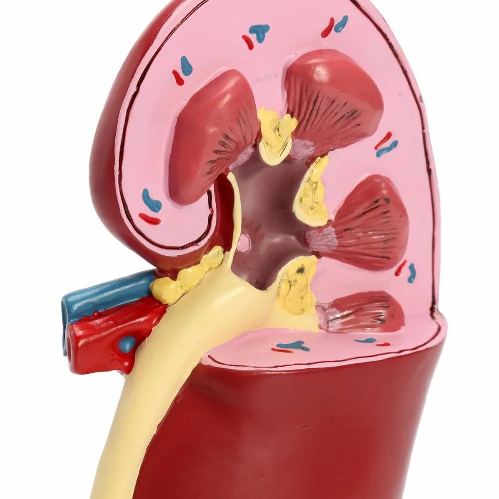 Patologias renais modelo anatomia do corpo humano réplica de rim doente para médicos escritório ferramenta educacional gpi anatômicas