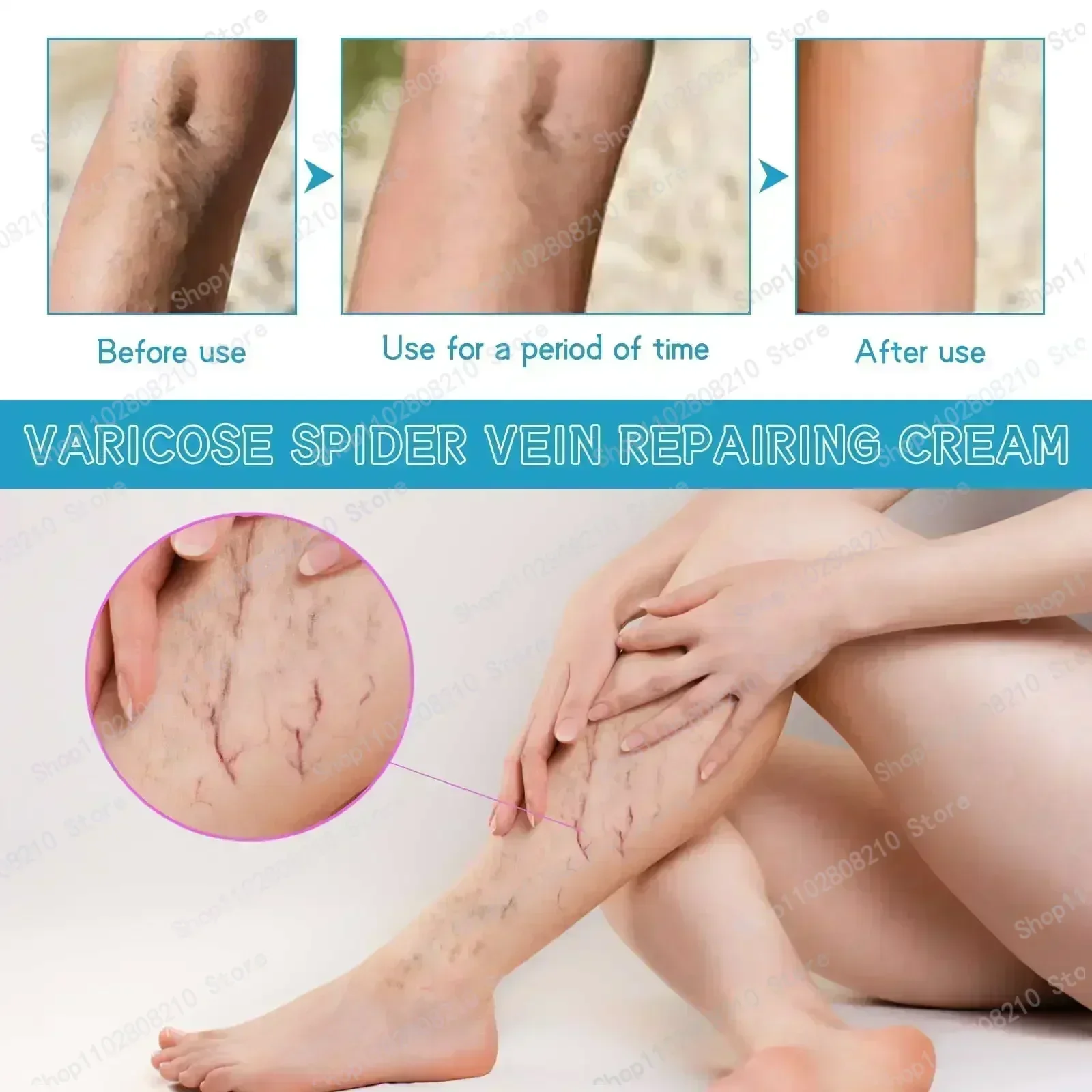 Cream leg skin irritates and soothes venous tension