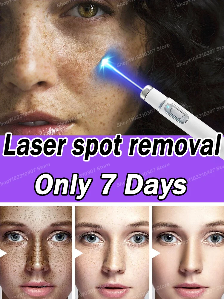 Blu-ray laser! Physical spots disappear! Break down melanin