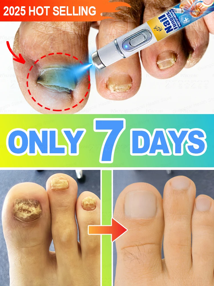 تساعدك على التخلص من فطار الأظافر. حل مشاكلك بالطرق العلمية. #1