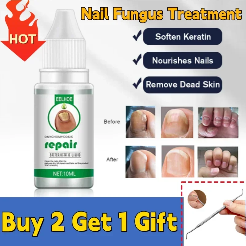 Nail Fungus Treatment Serum Repair Fungus Removal Essence Liquid Onychomycosis Foot Care Gel Anti Infection Thicken Soft Nails