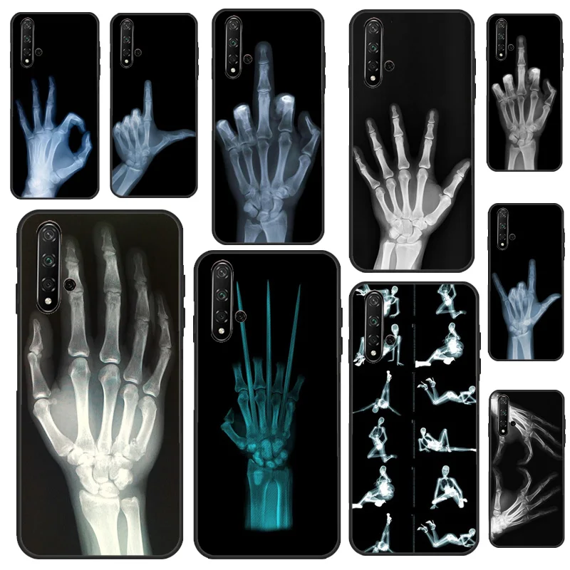 X-Ray Hand Bones Fo… - image
