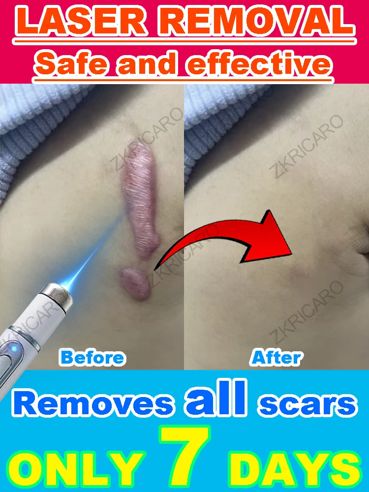 

Новейшая лазерная технология восстанавливает натуральную кожу без шрамов.