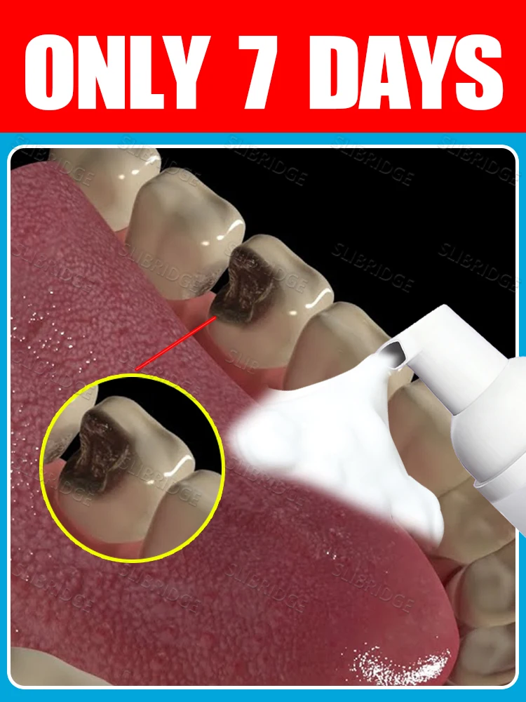 

2025 hot sale Mousse shield, no way to decay.,Intraoral Mousse clean tools