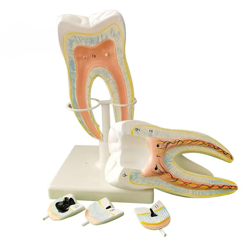 

Модель анатомии больших зубов с 10-кратным увеличением, съемная, для обучения стоматологии, демонстрации кариеса на жевательных зубах