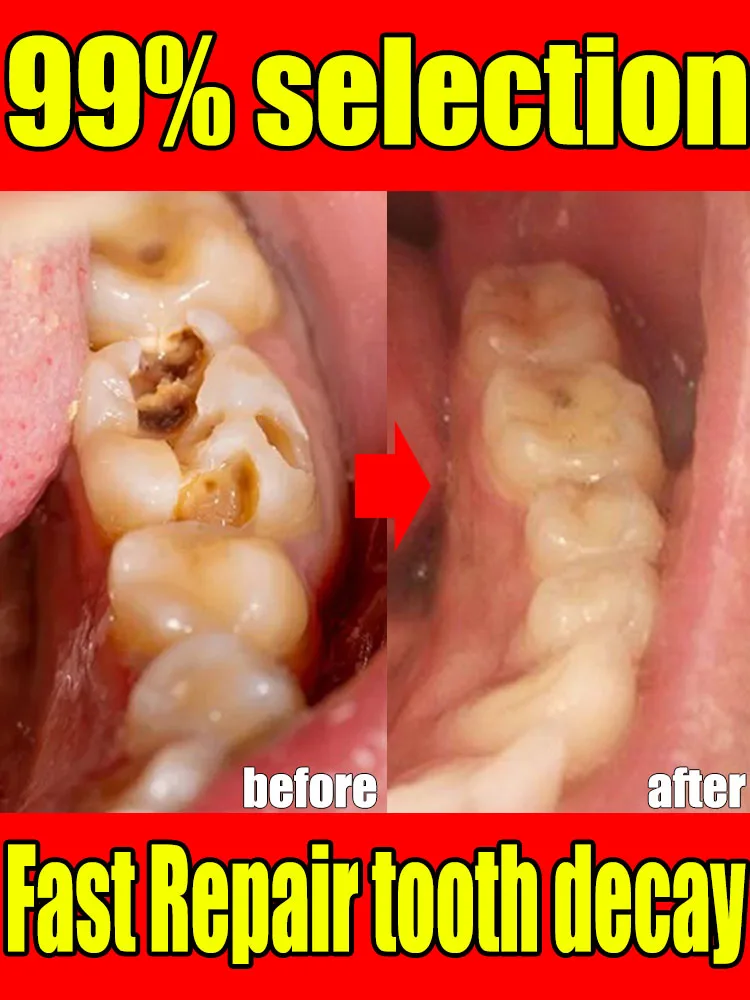 tooth decay repair cavities protect teeth