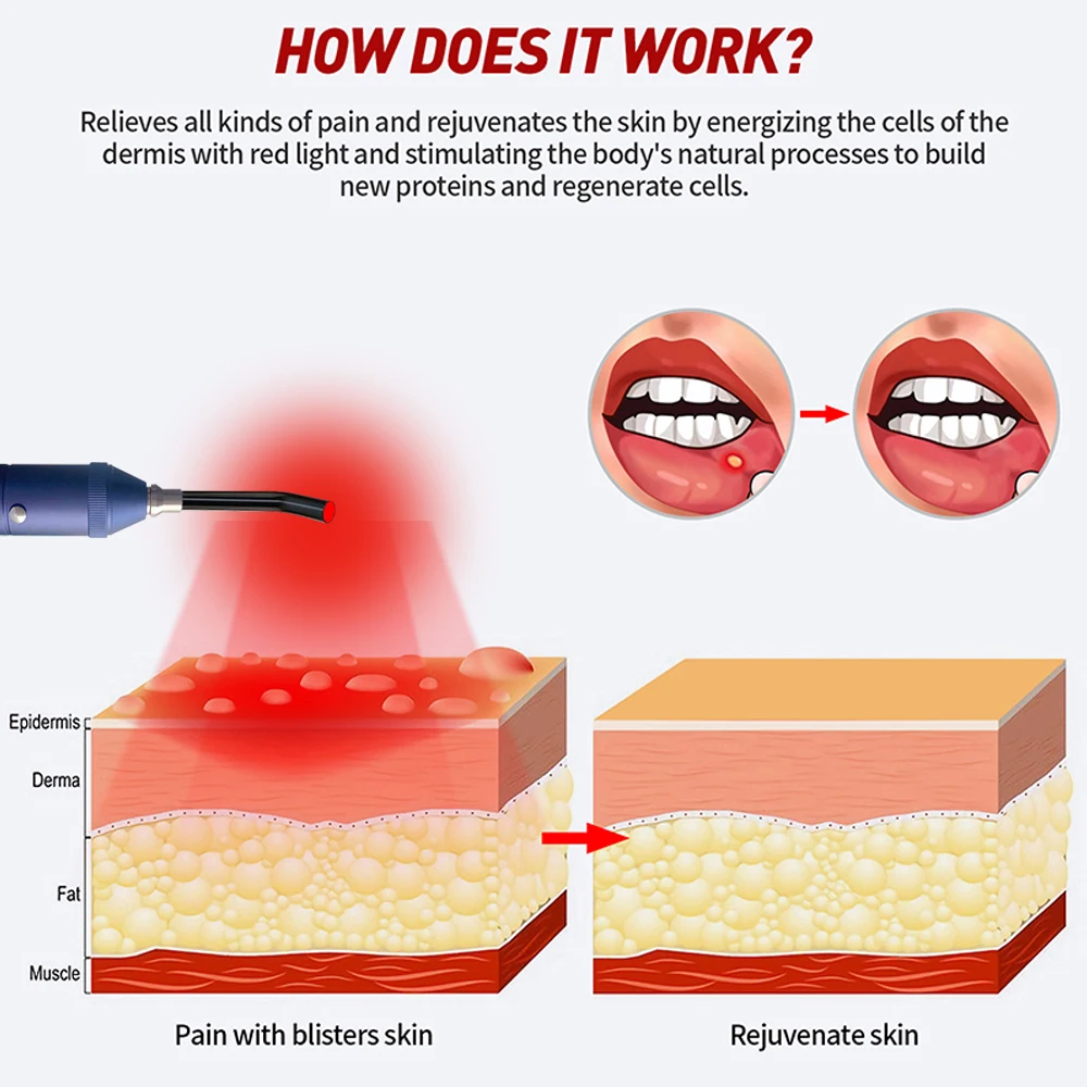 Terapia de lábios doloridos, Dispositivo de terapia infravermelho portátil luz vermelha, Varinha de fisioterapia oral removível, Alívio das dores