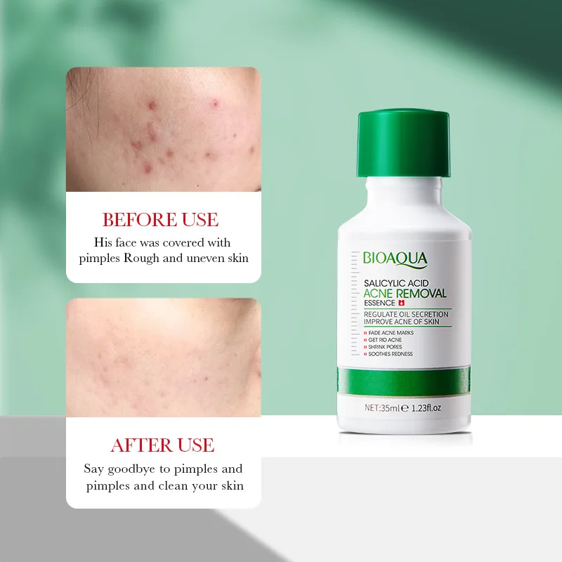 Salicylic Acid Acne…