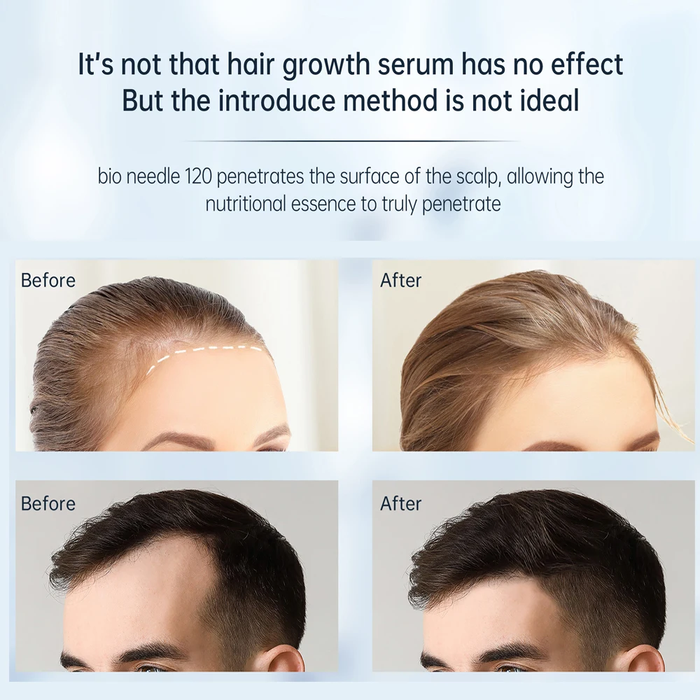 ديرما ختم 120 دبوس إبر قلم إبرة مجهرية لإعادة نمو شعر اللحية الوجه العناية بالبشرة ديرما الأسطوانة جهاز الجمال