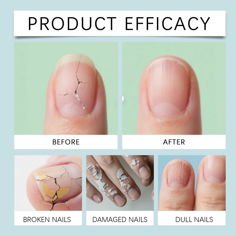 7days Nagel Pilz Behandlung Serum Ingwer Anti-infektiöse Paronychie Onychomykose Kappe Fuß Nagel Pilz Reparatur Gel Hand Fuß pflege