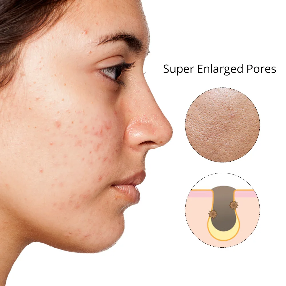 5 IN1 超音波ヘッドマシンスキンケアニキビ跡除去皮膚剥離 LED マスク