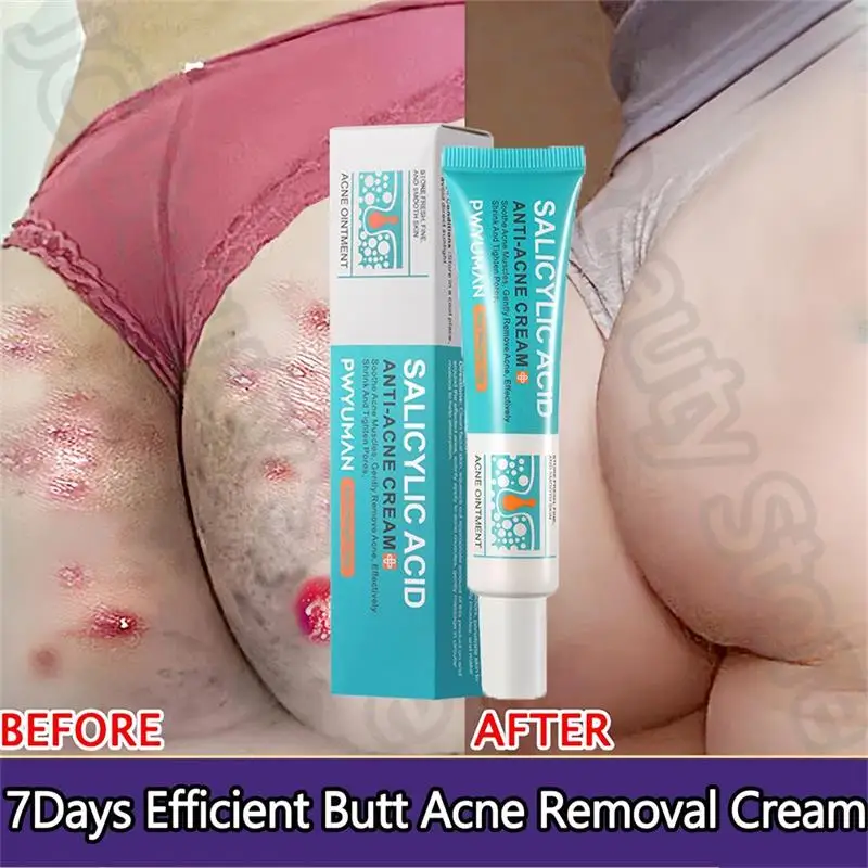 Salicylic Acid Acne Serum Cream Effective Treatment Hip Butt Acne Face Acne Back Acne Fade Acne Marks Whitening Smooth Skin Care