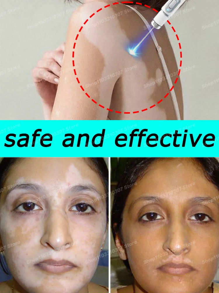 

Vitiligo Cream The Skin Repair