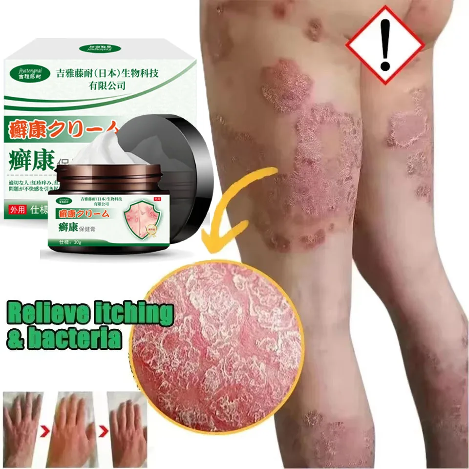 Ringworm Health Care Cream, Summer Anti-itch Cream, External Use Skin Itching, Ringworm Itching, Red Rash Health Care Cream