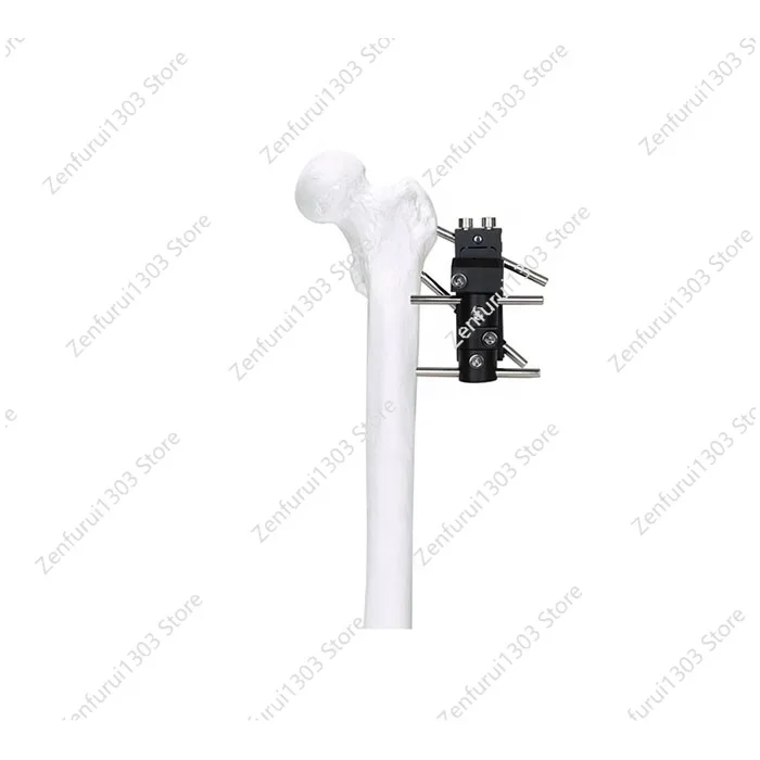 

Popular Orthopedic External Fixation Rotor External Fixator