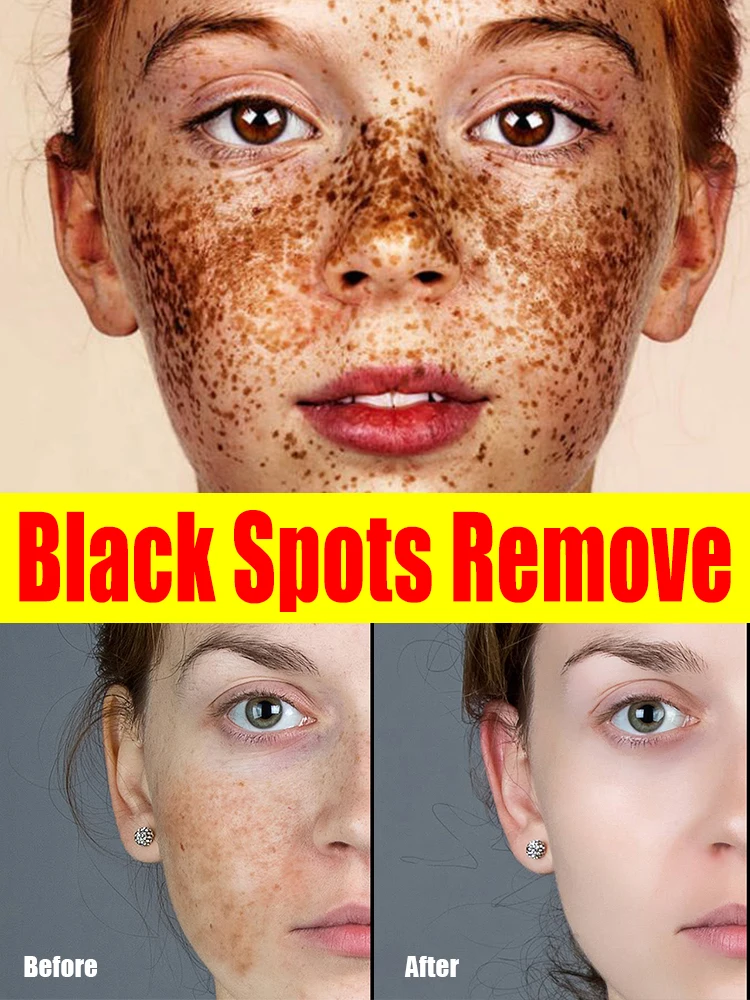 

Black Spot VC Removal Melasma Dark Spots Corrector Lighten Melanin Pigmentation Brighten Anti-Aging