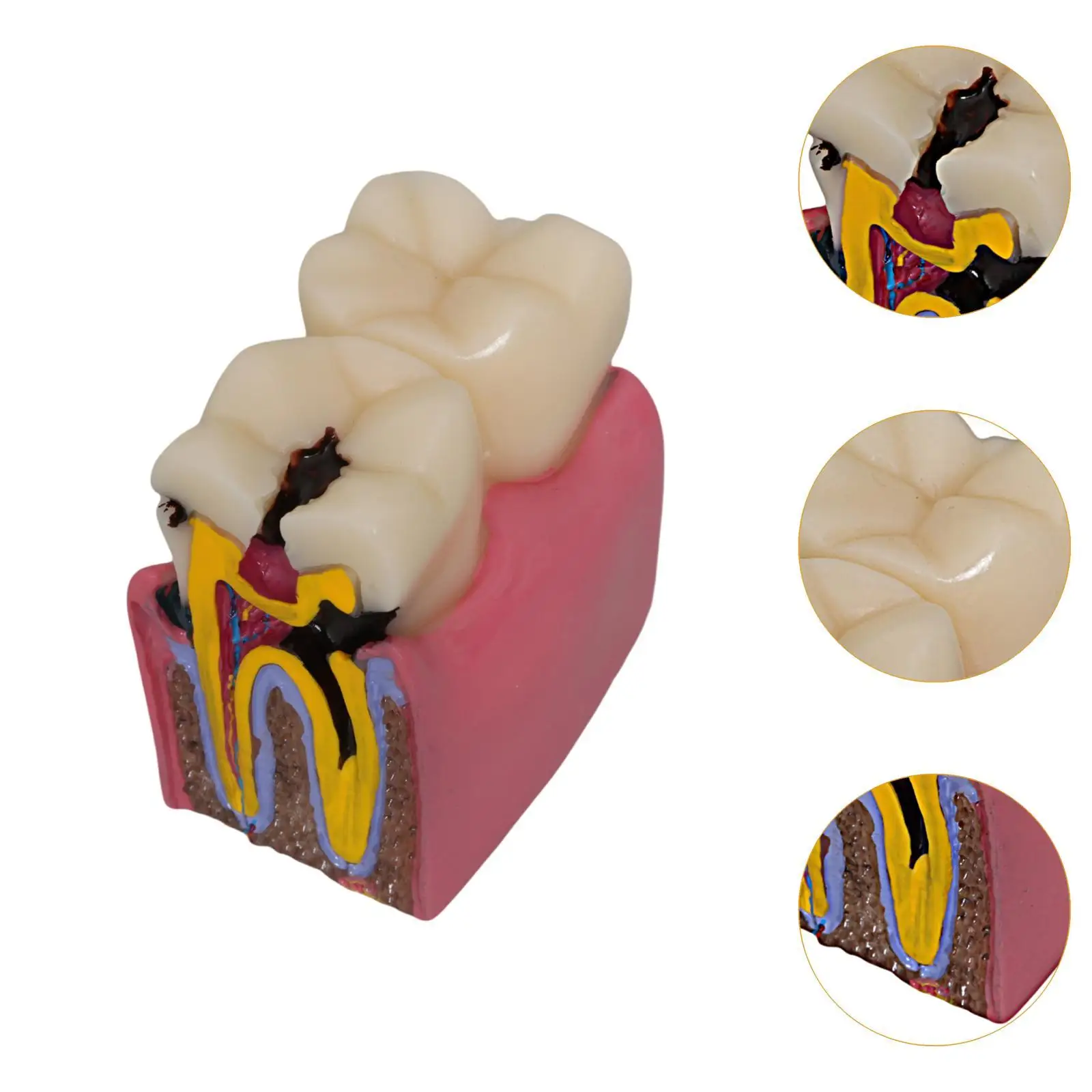Caries Tooth Model 6 Times Teaching Prop Morphology, Resin ,Tooth Teaching Display for Studying Students Class Education Kids