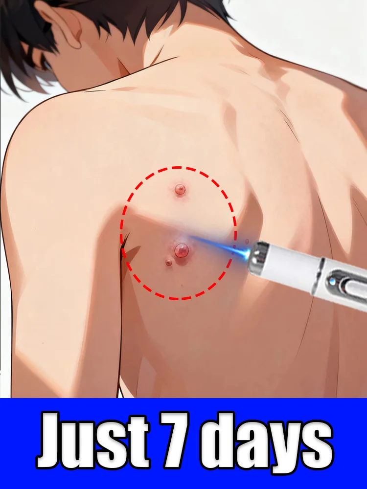 

The best-selling wart tool on the Internet, seven days to say goodbye