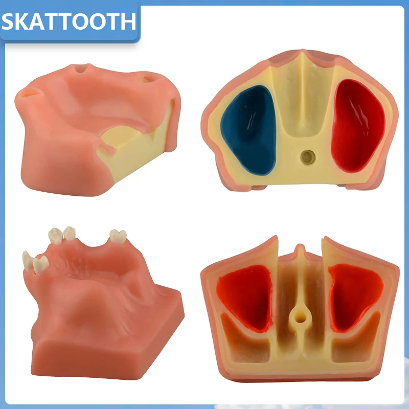 

Dental Implant Model with Soft Gums Upper Jaw Sinus Lift Implants Restoration Maxillary Sinus Model for Training Teaching Demo