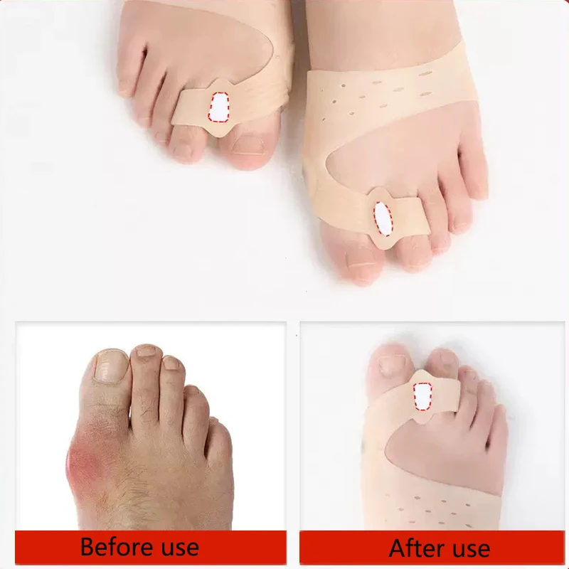 6 Pcs Bunion Correctors – Elastic Forefoot Sleeves with Toe Separators