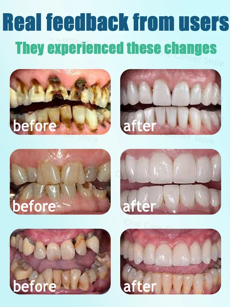 Hot selling product, 99% of buyers will buy again, teeth are getting better and better, fast effect, no more cavities