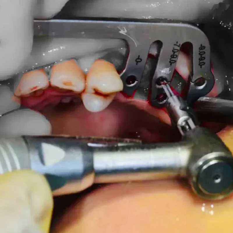 Professional Lab Implants Guide Set Orals Plantings Locator Drillings Positionings Ruler Angle Rulers Lab Implants Tools