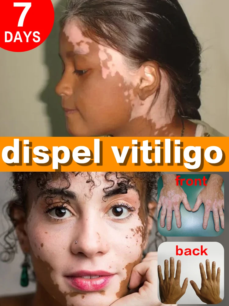 Traitement efficace de la crème de dessalement du vitiligo, produits de tache blanche