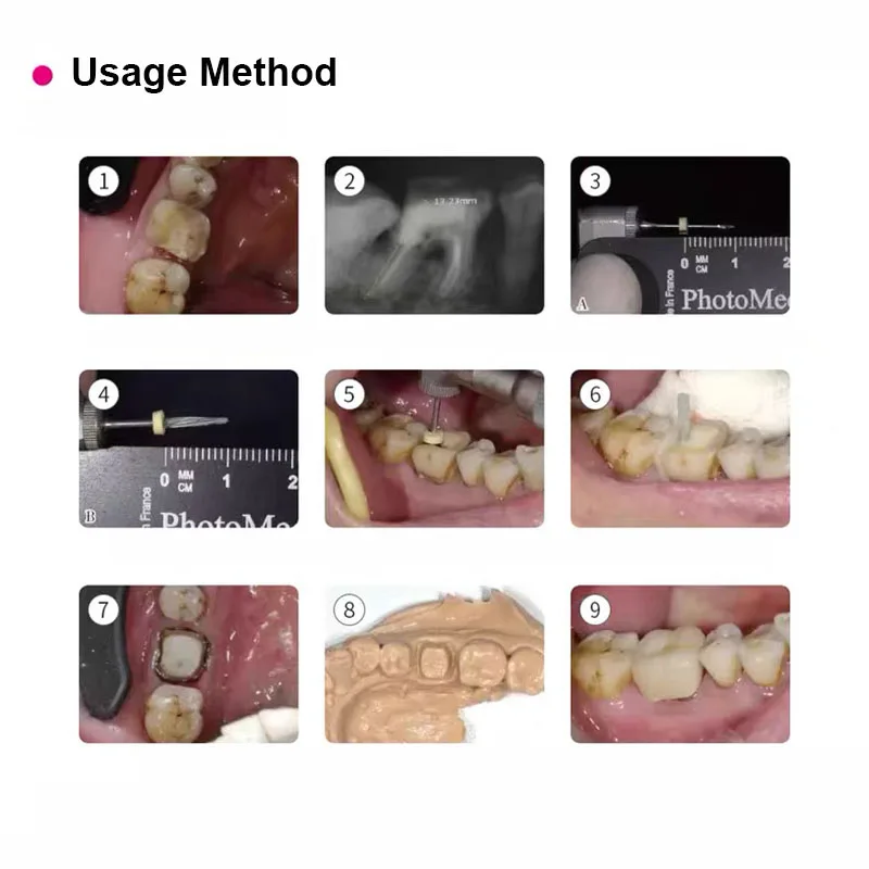 1.0/1.2/1.35/1.5mm Dental Refill Restorative Filling Materials I-Type Glass Fiber Reinforced Composite Resin Root Canal Pile