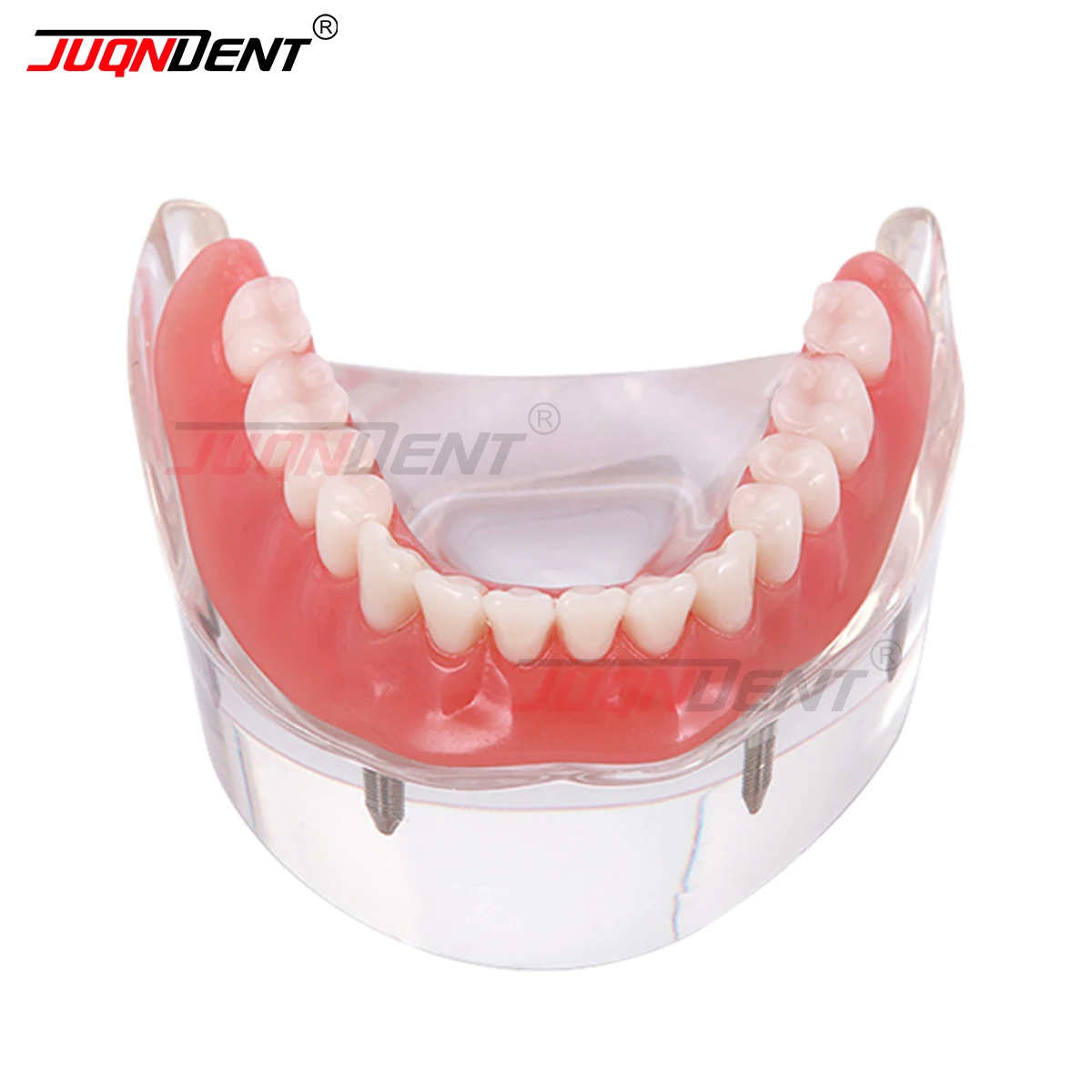 Dental Teeth Model Dental Typodont Model Implants Restoration Over Denture Inferior Study Demo Jaw Education Study Teeth Model