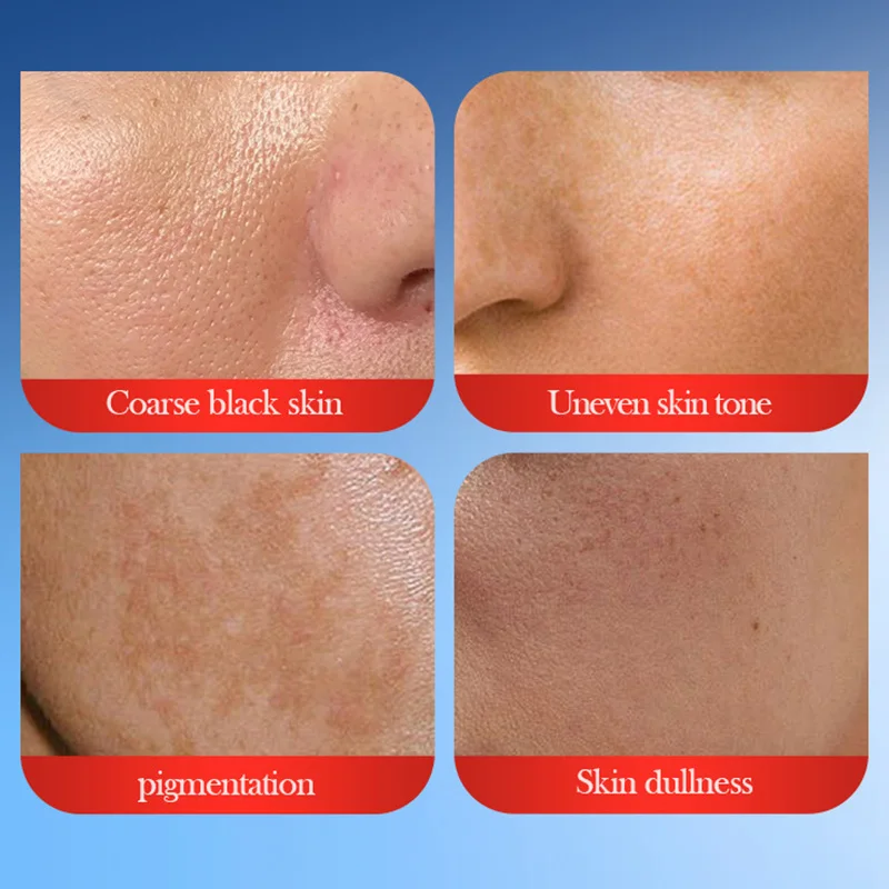 SADOER Crema anti-lentiggine Creme sbiancanti Lentiggine Rimozione Anti-età Idratante Siero viso Cura della pelle del viso